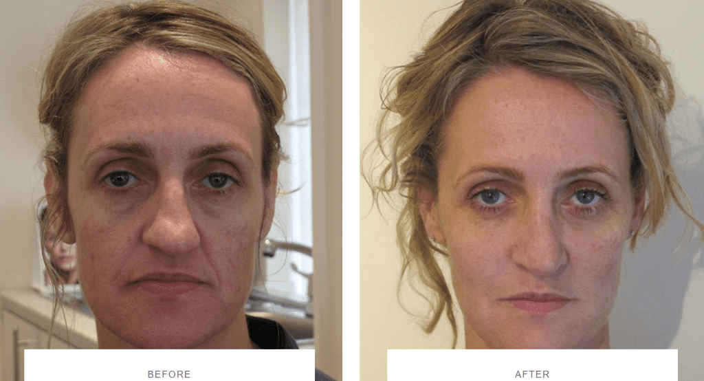 full face rejuvenation before and after