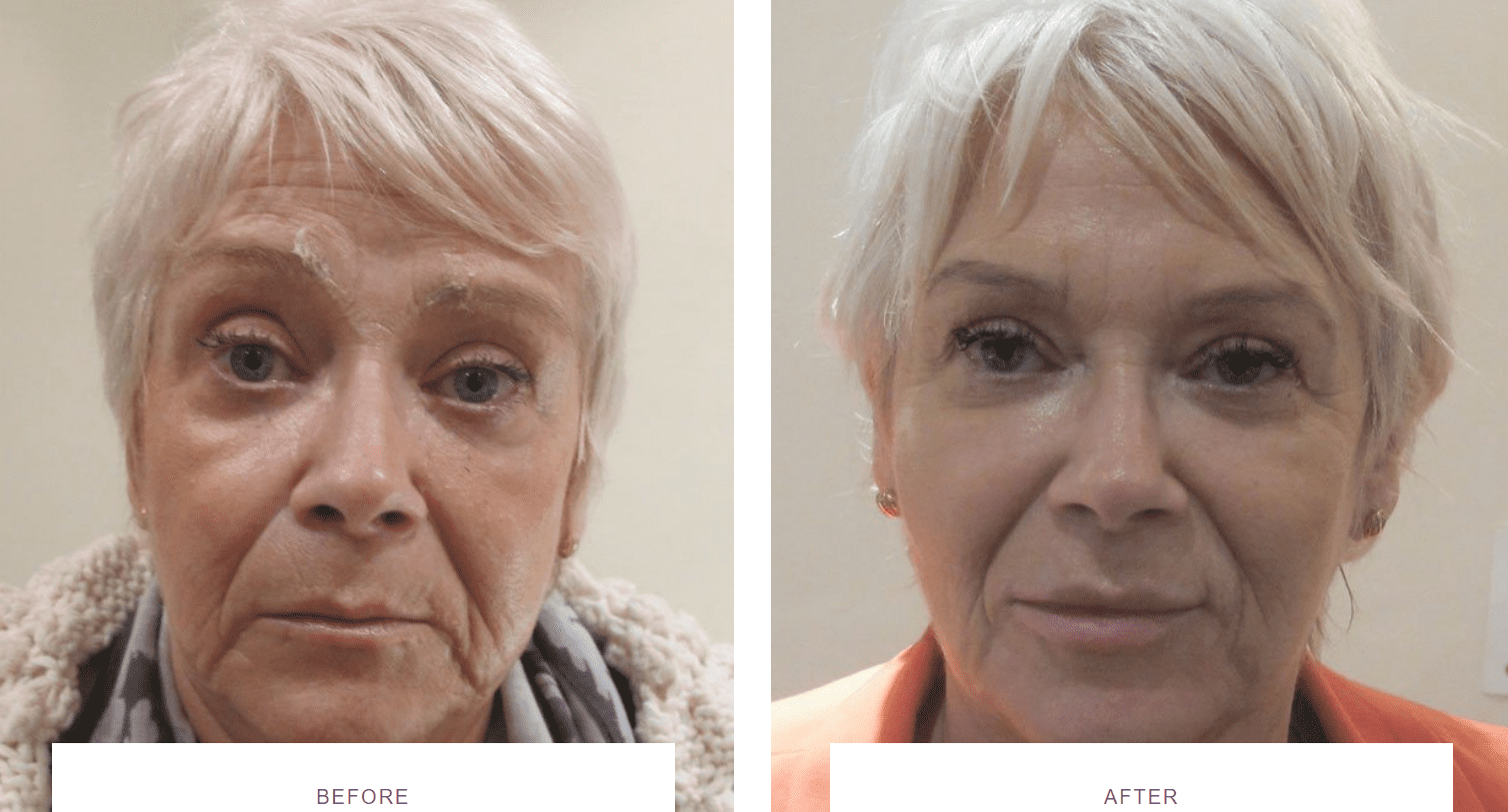 facial rejuvenation with dermal fillers