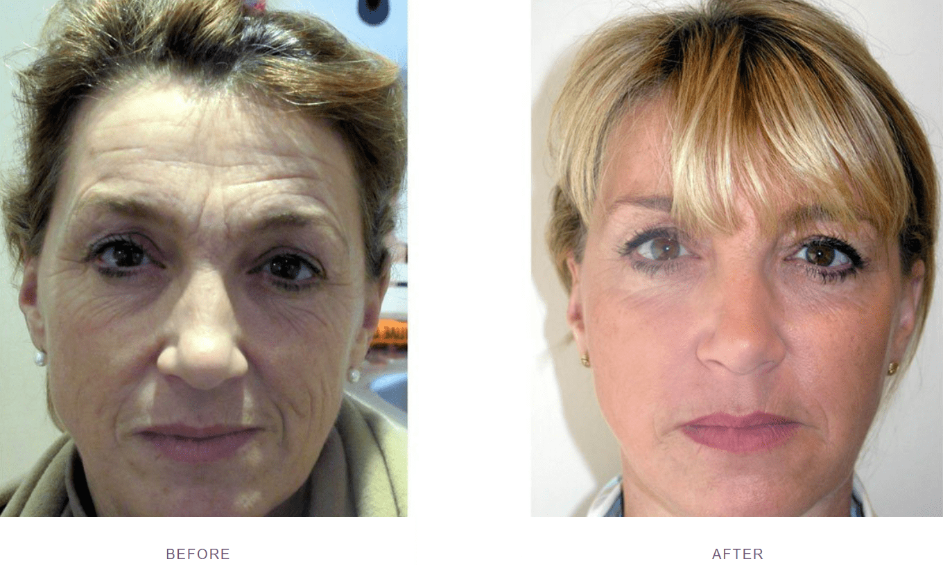 wrinkly face before after dermal fillers