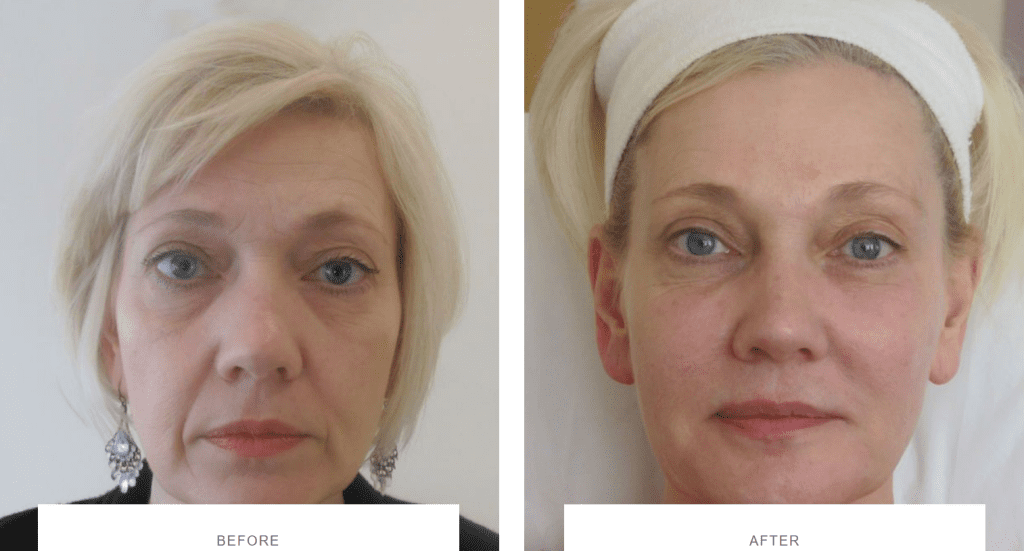 full face rejuvenation fillers before and after
