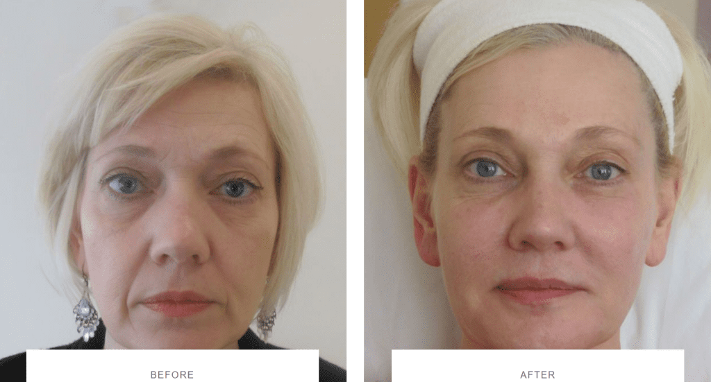 cheek fillers full face rejuvenation before after