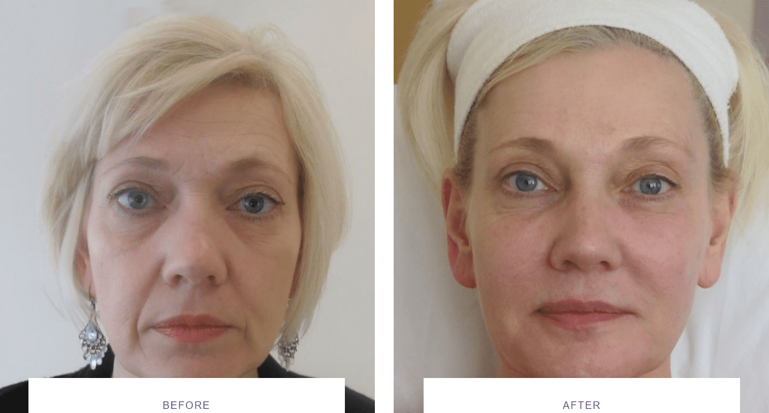 facial wrinkles treatment with dermal fillers