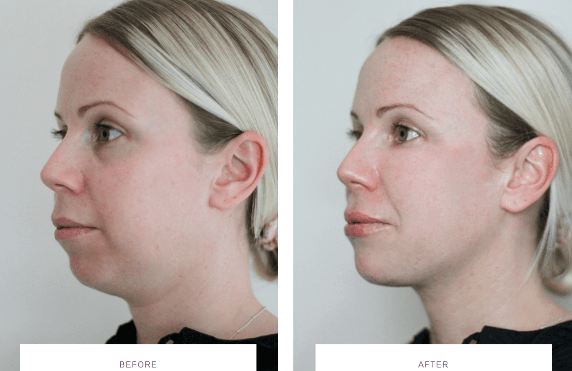 chin augmentation with dermal fillers