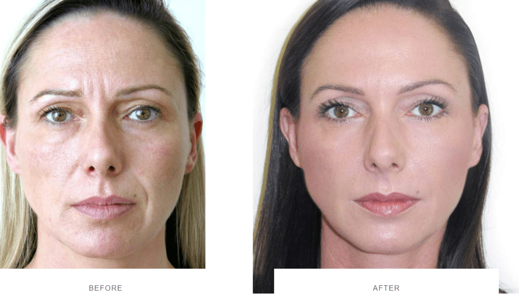 full facial rejuvenation before and after