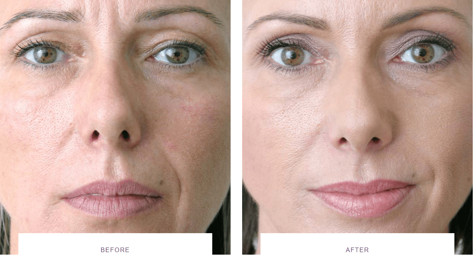 facelift with dermal fillers