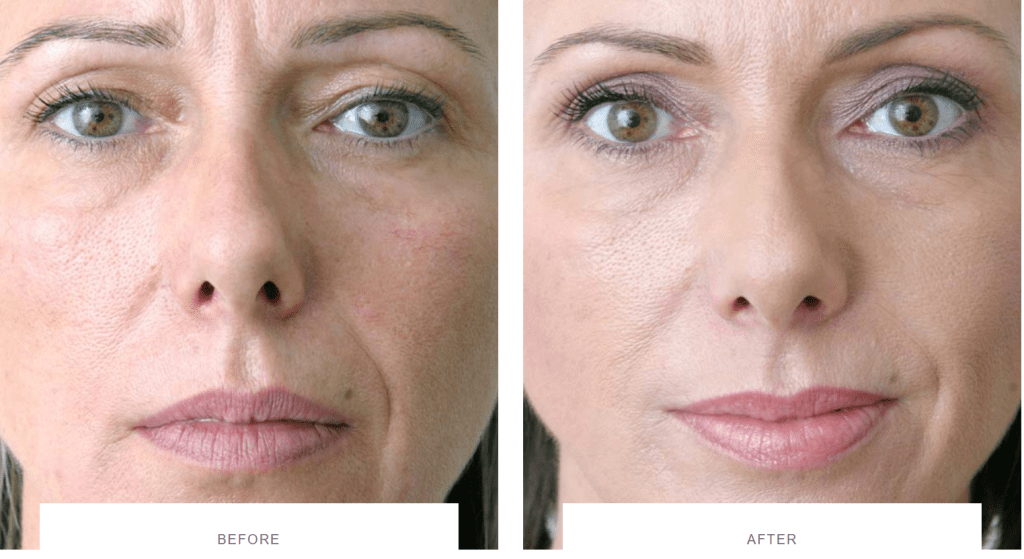 facial rejuvenation before and after