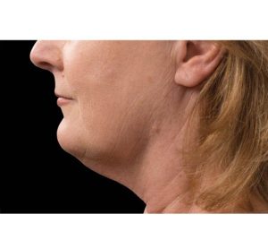 Double Chin CoolSculpting Fat Removal After