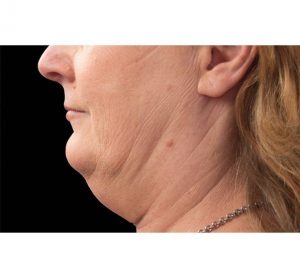 Double Chin Fat Removal Before