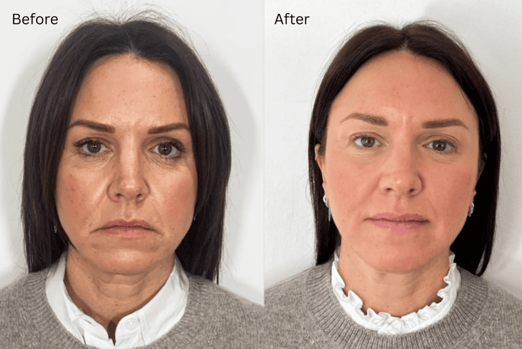 Downturned Mouth Corners: What Causes Them and How Are They Treated?