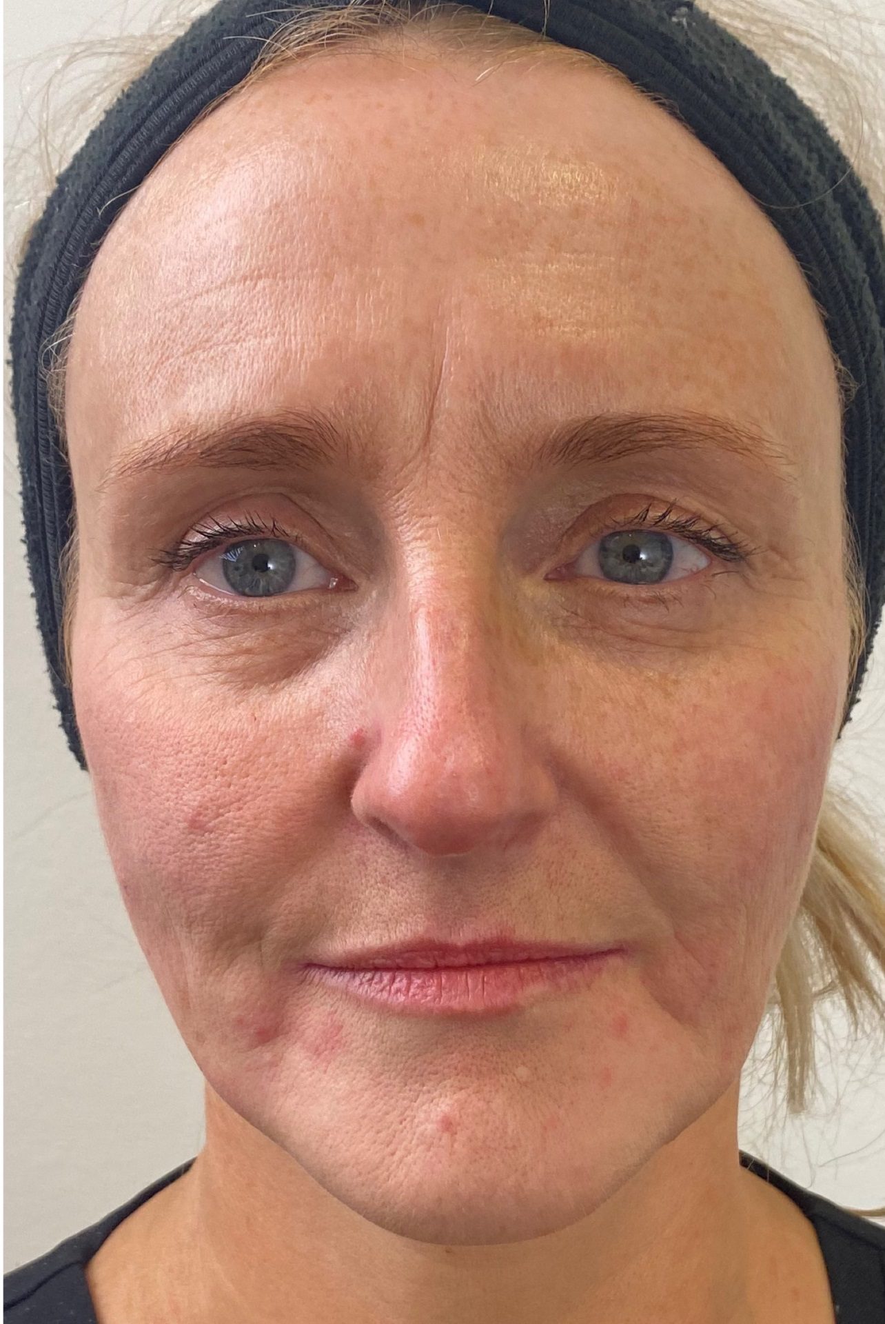 Dr Johanna Ward Lower Face lift Dermal Filler After