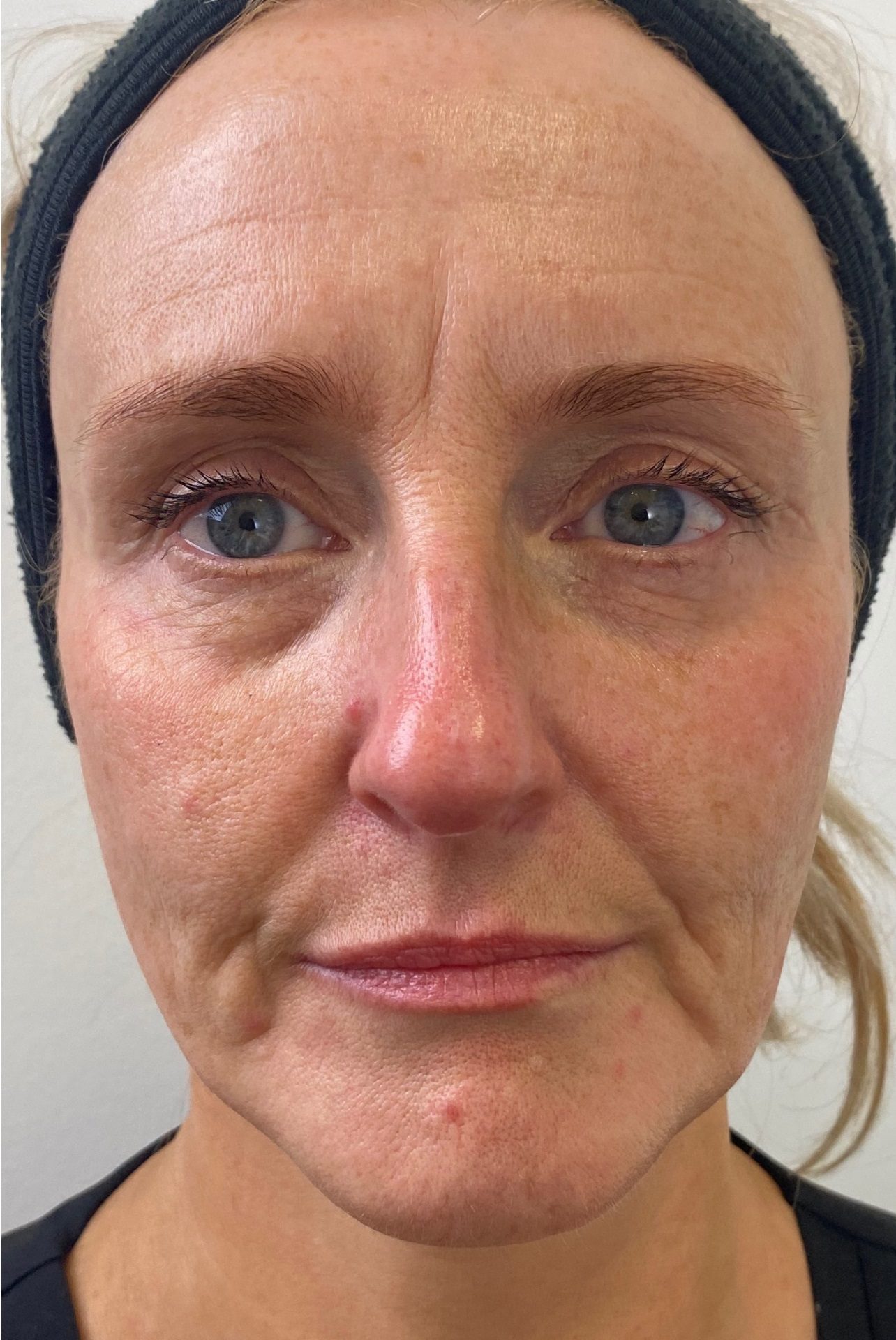 Dr Johanna Ward Lower Face lift Dermal Filler Before