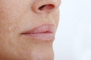 Lips After Restylane Vital Light