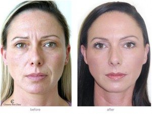 Muscle relaxing treatments help to soften forehead lines