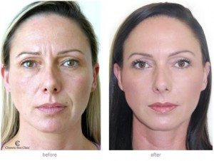 Muscle relaxing treatments help to soften forehead lines Muscle relaxing treatments help to soften forehead lines