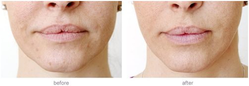 Lip fillers can be an effective way of removing lines in the lip area
