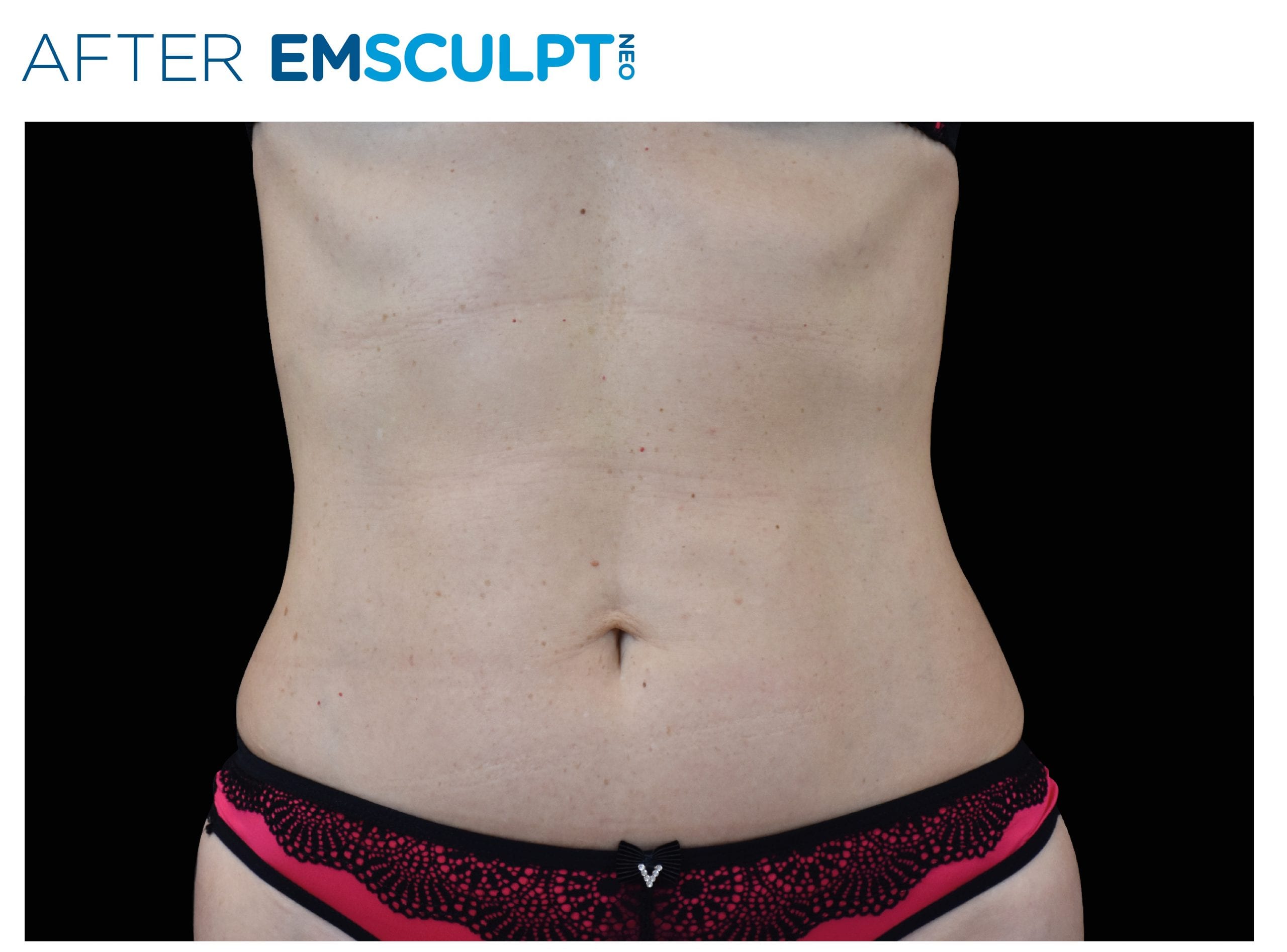 EMsculpt Neo After Treatment photo woman