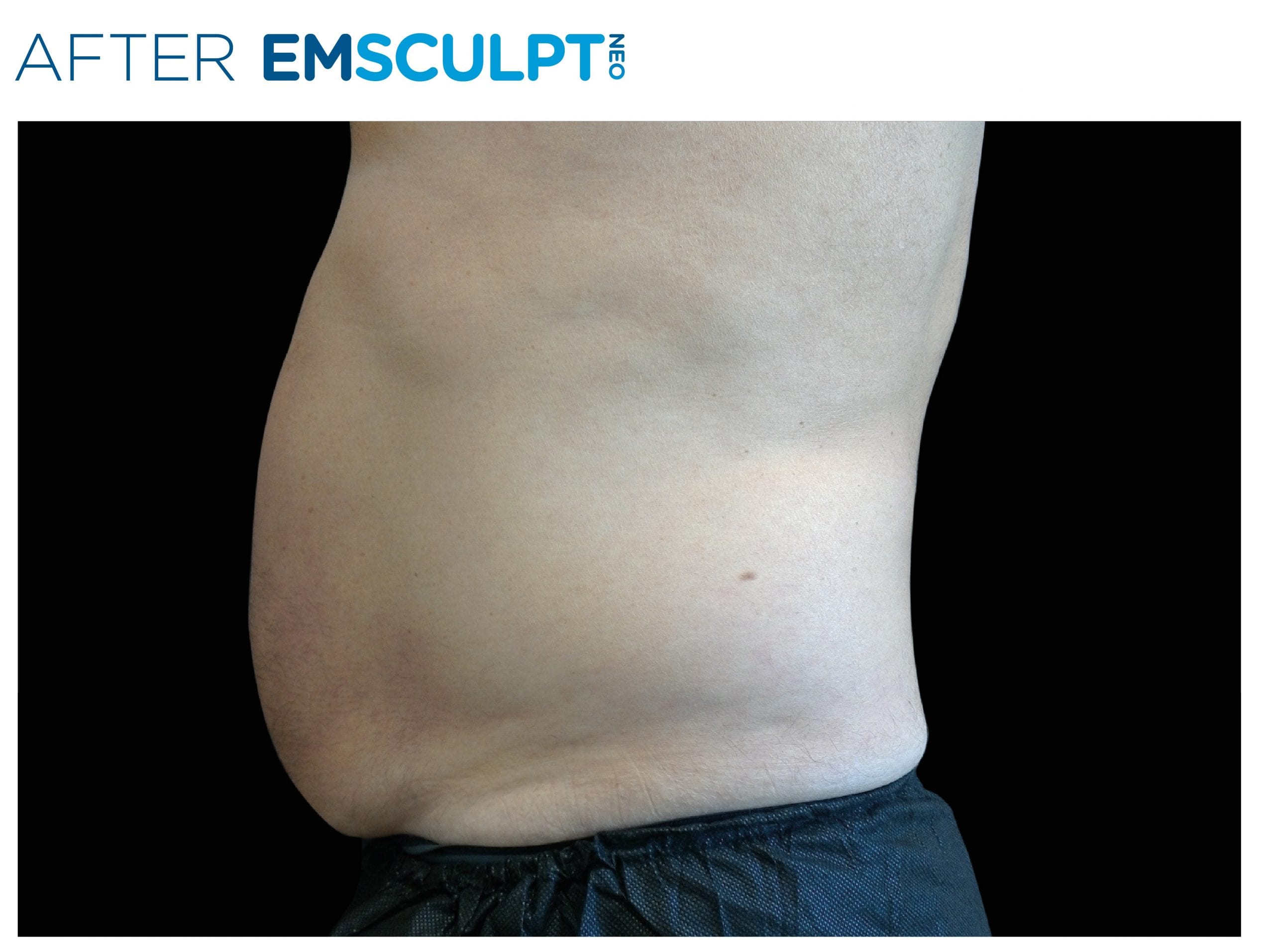 EMSculpt Neo After Treatment photo man