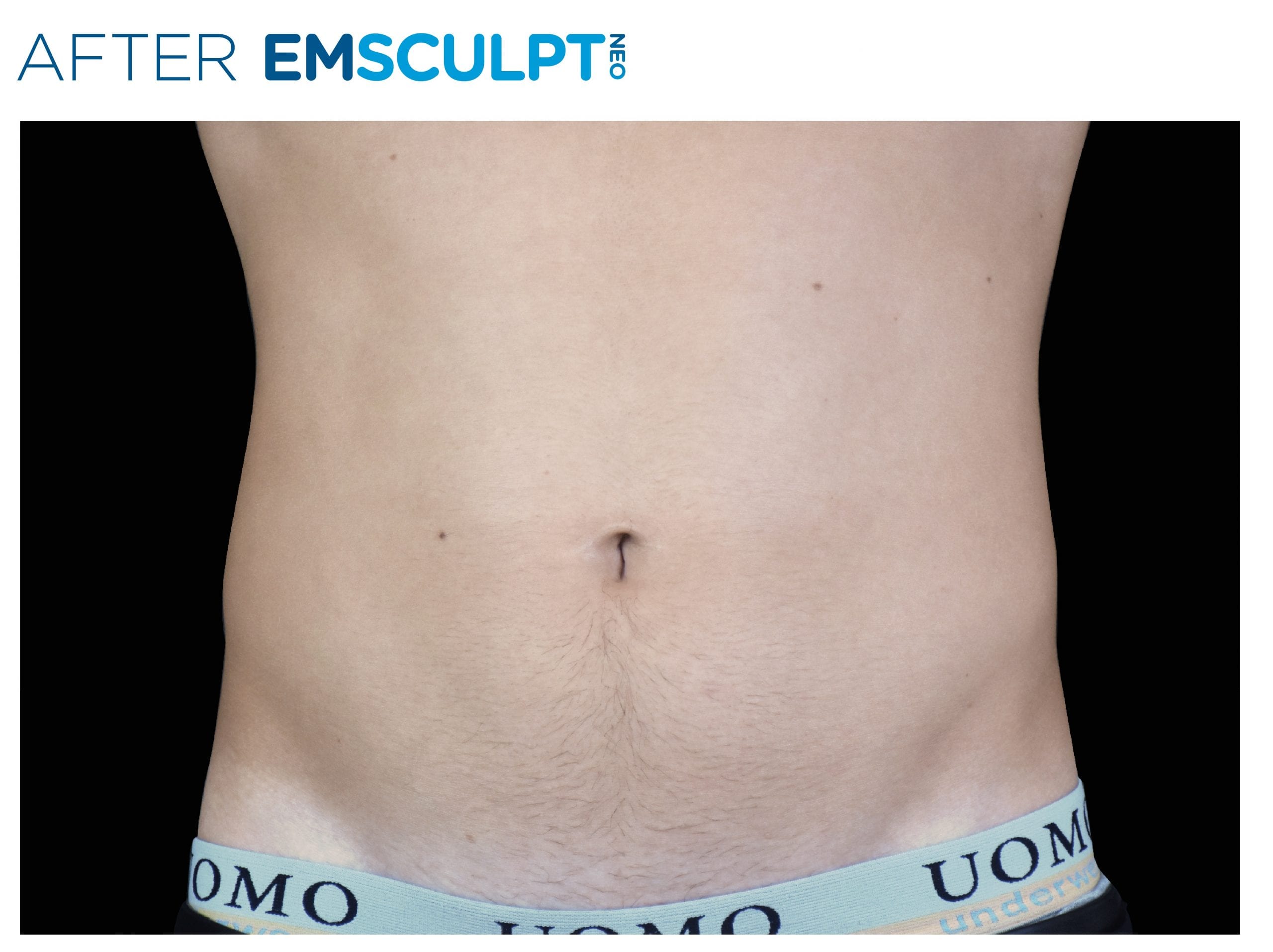 Emsculpt Neo Treatment After picture man's belly