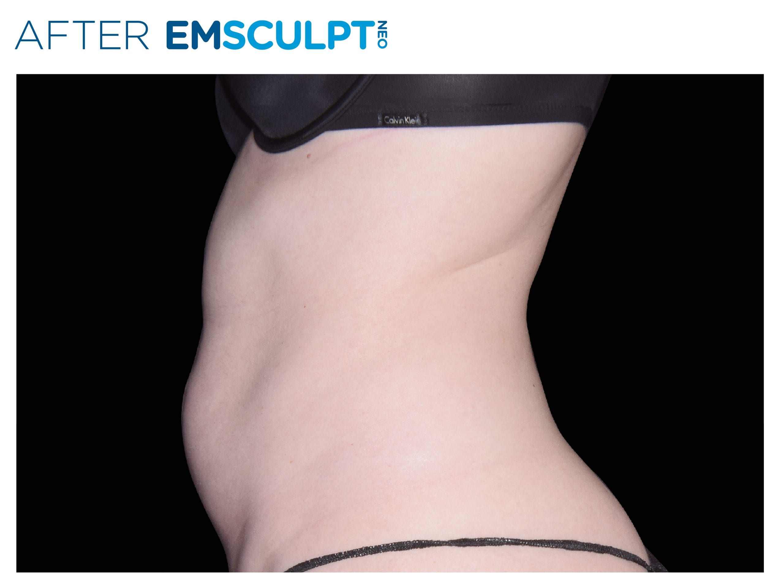 Emsculpt Neo After Treatment photo woman side view