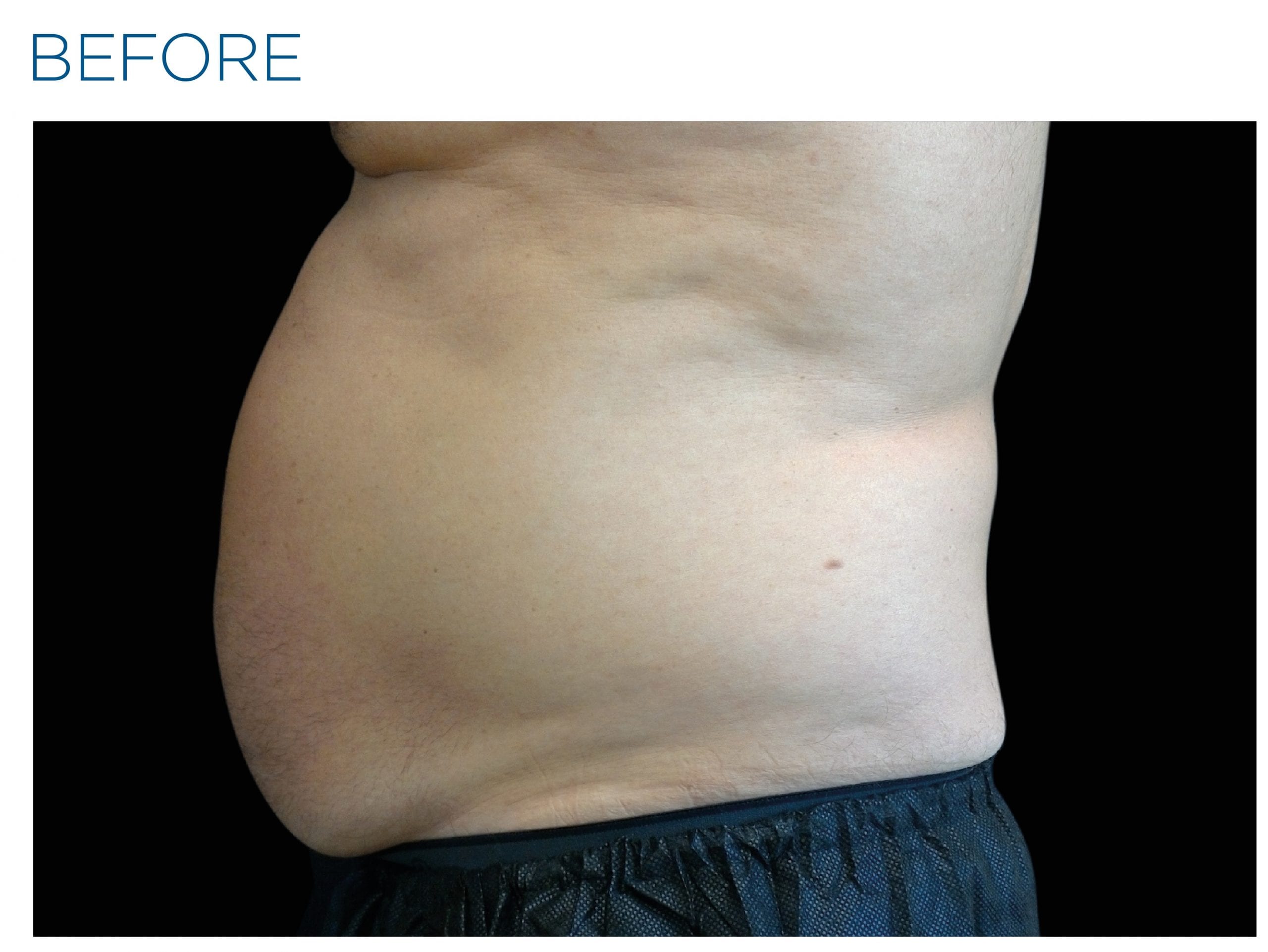 emsculpt neo before and after emsculpt neo before and after