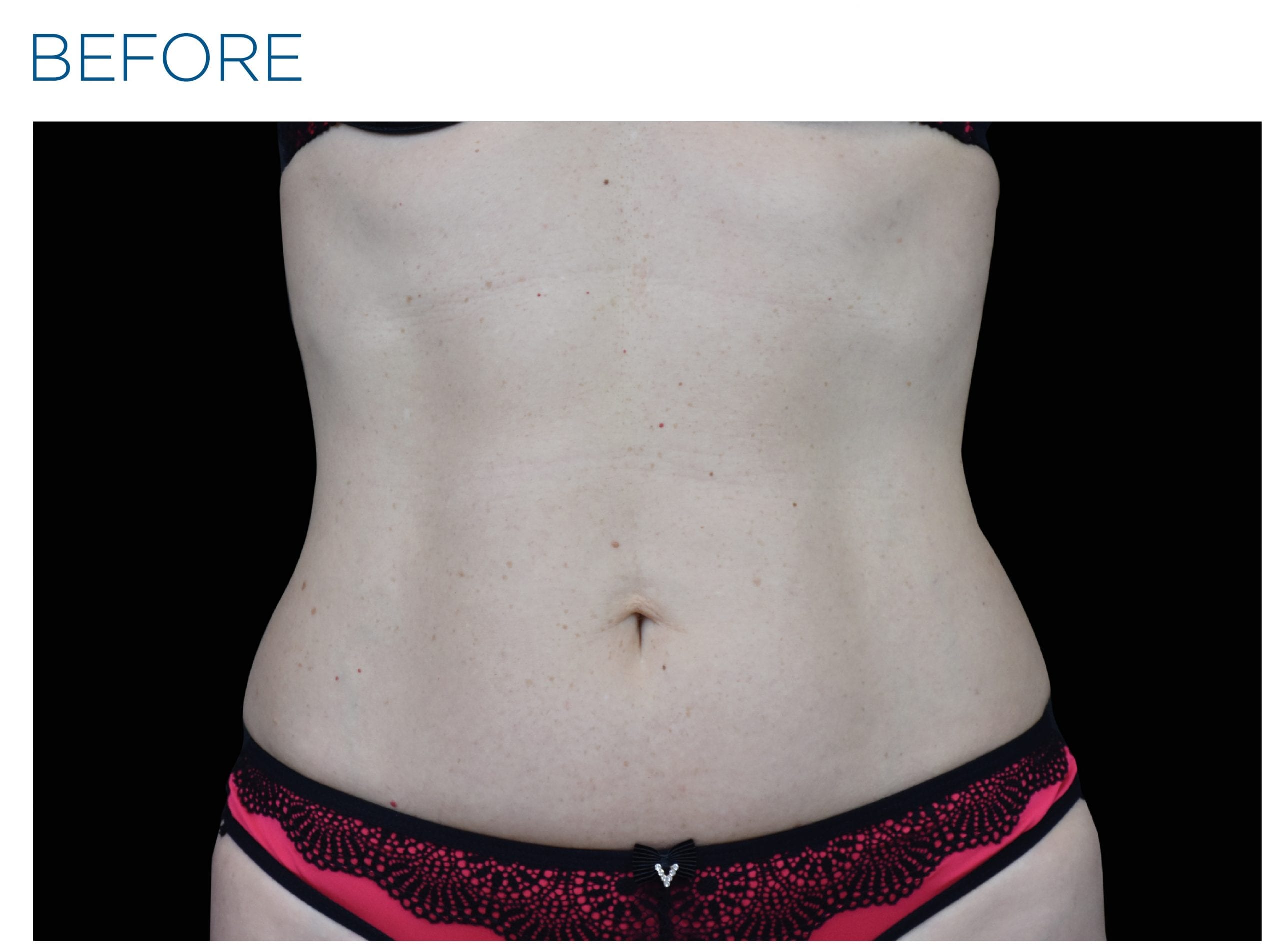 EMSculpt Neo Before Treatment photo woman