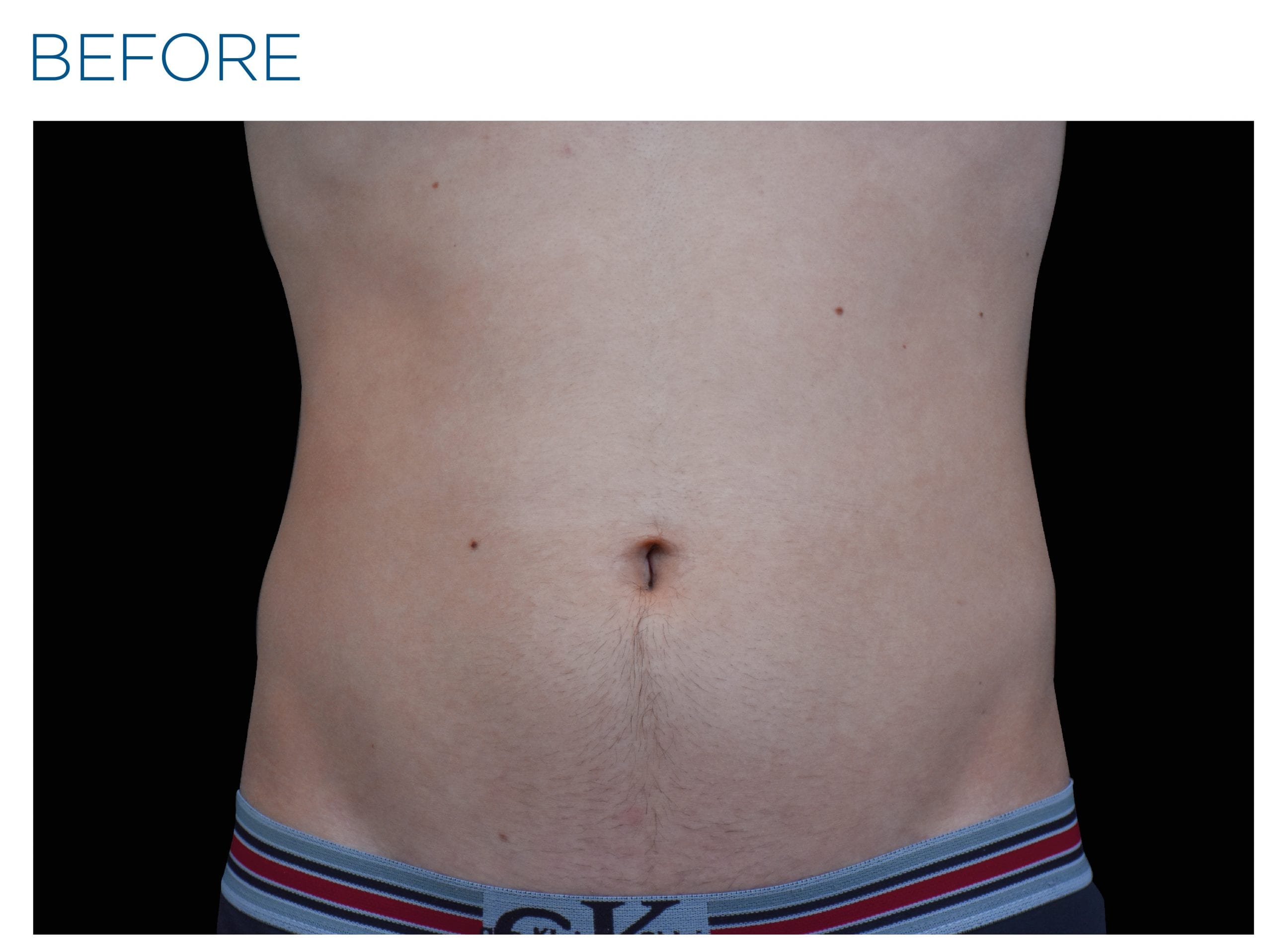 Emsculpt Neo Before Treatment picture man's belly