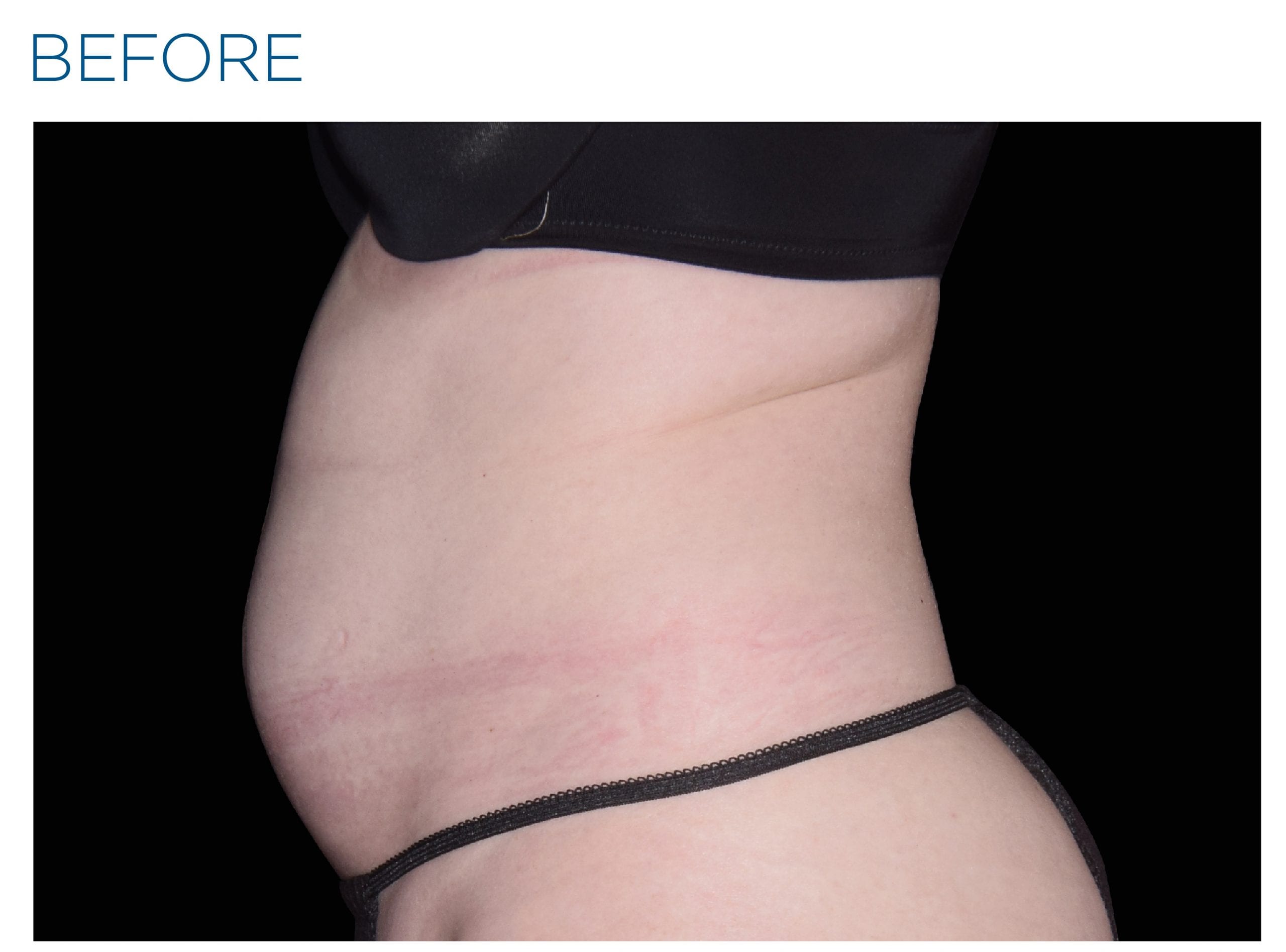 Emsculpt Neo Before Treatment photo woman side view