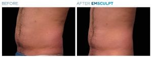 EMSculpt Abdomen Male Before After