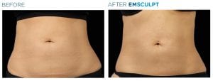 EMSculpt Abdomen Female Before After