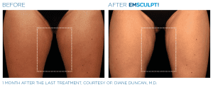 emsculpt neo thigh gap before and after front