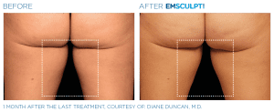 emsculpt neo thigh gap before and after back