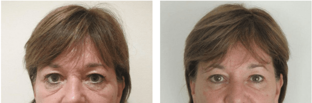 eye fillers before and after