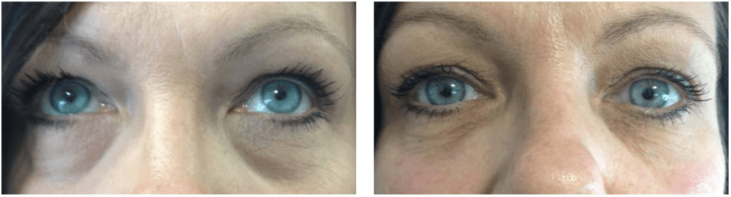 dark circles under eyes before after