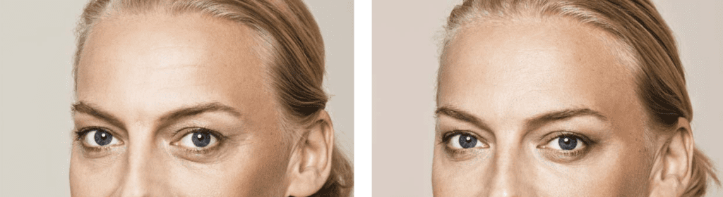 eye fillers for tired eyes before after