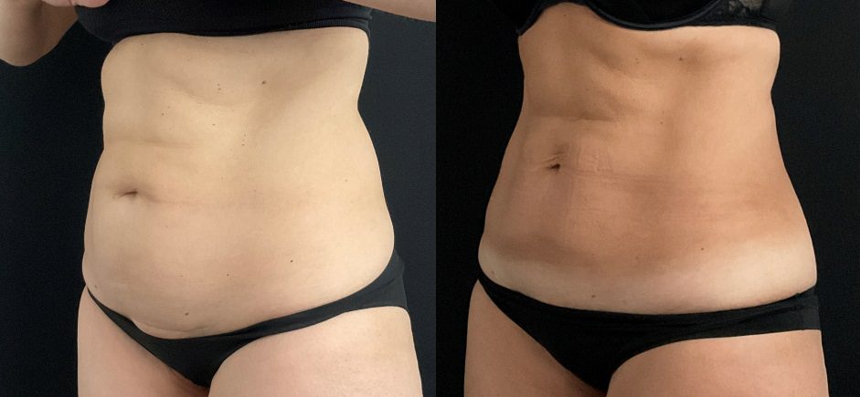 Fat freezing Abdomen Flanks hips before and after