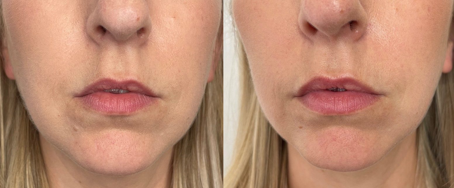 filler for barcode lip lines before and after