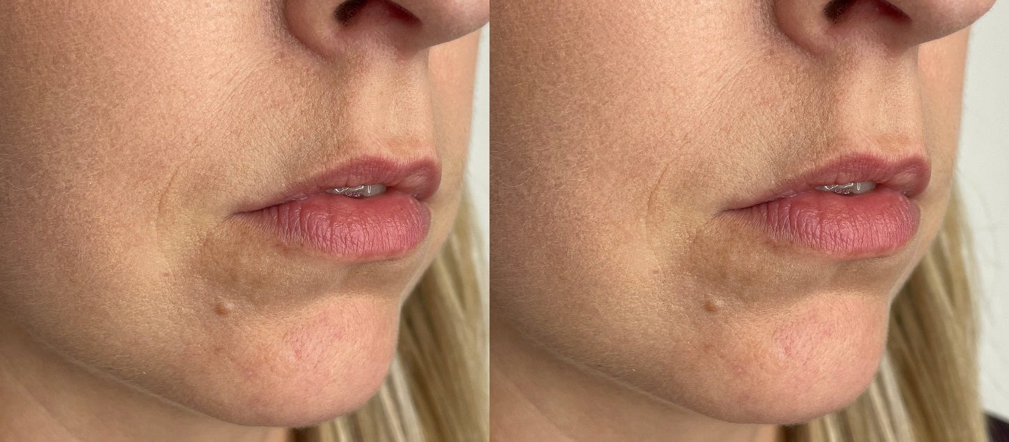 Filler for lip lines barcode lines before and after