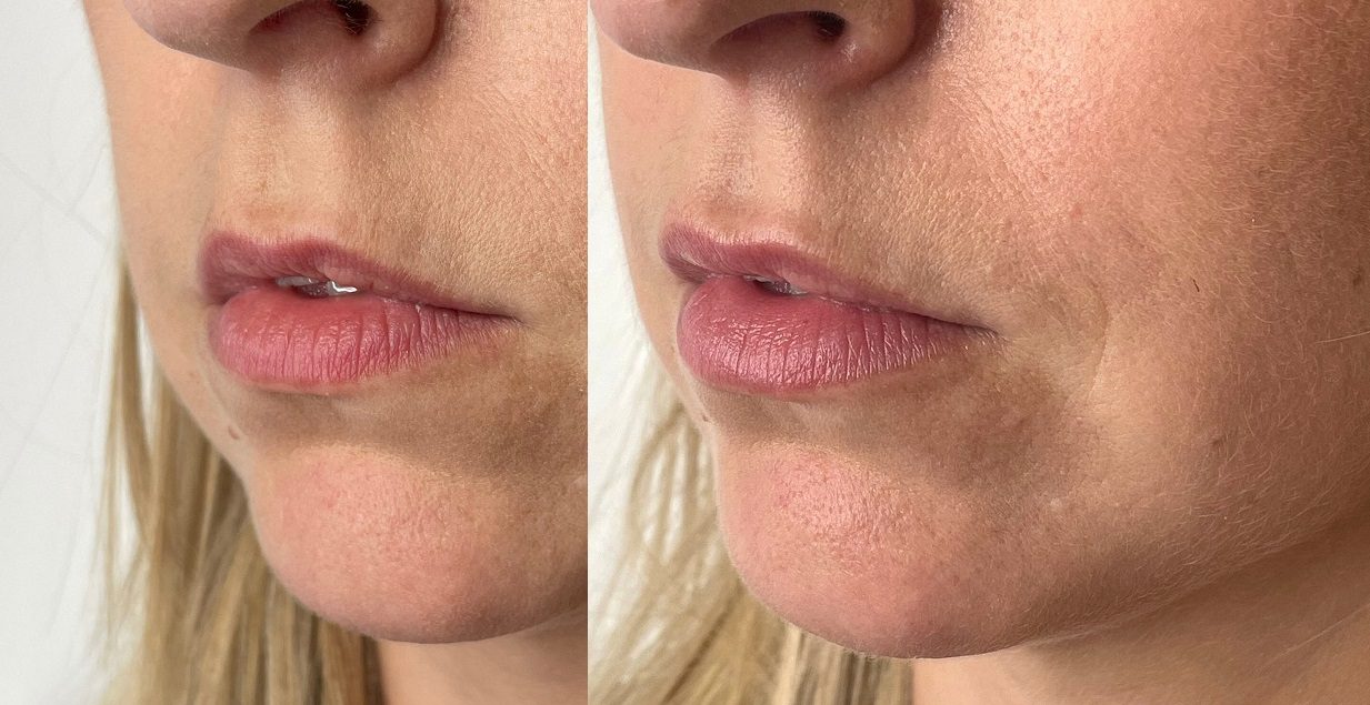 Fillers for barcode lines lip lines before and after