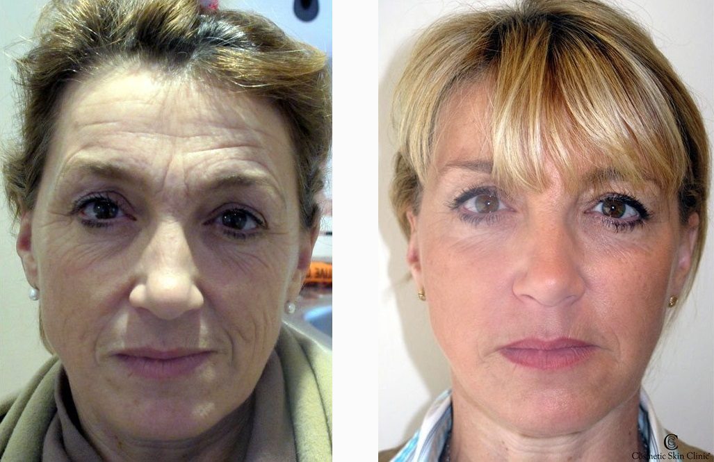 Fillers for fine lines and wrinkles on the face before and after