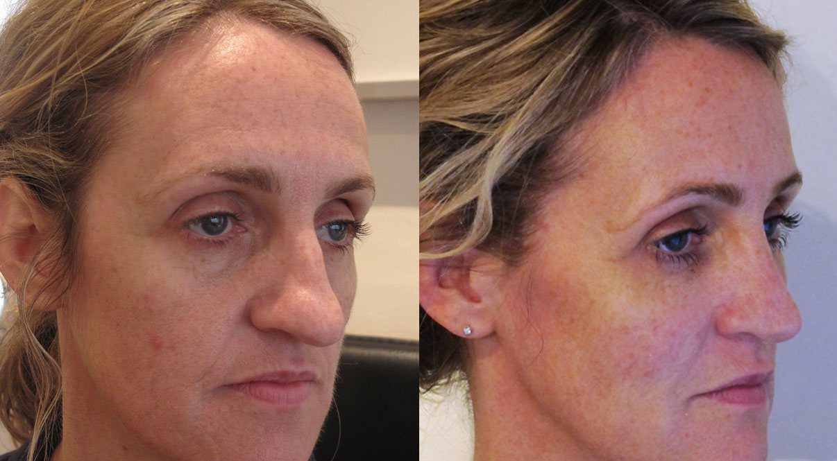 Fillers for jawline and nose to mouth lines before and after-side