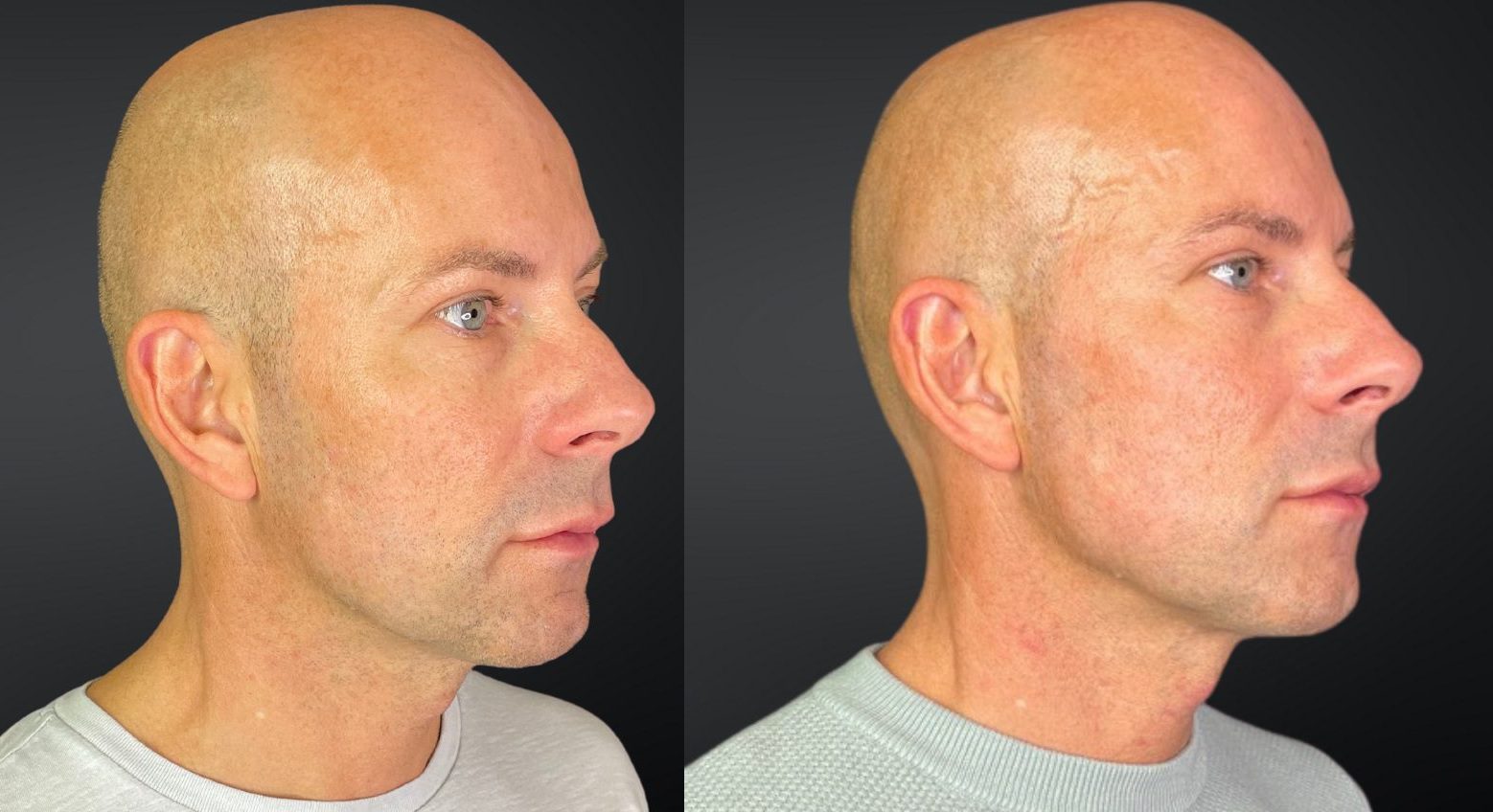Fillers lower face before and after