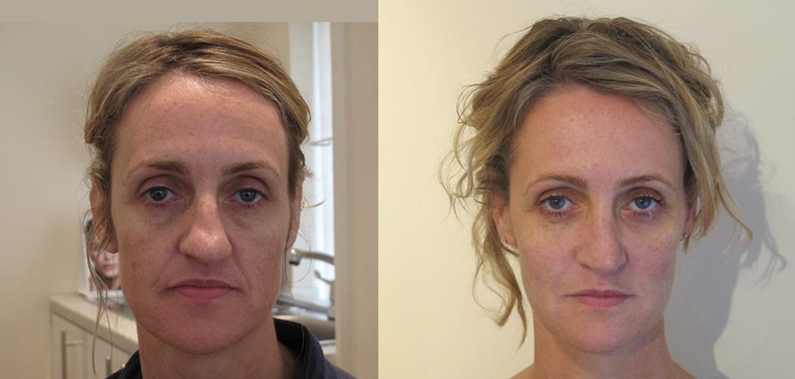 Fillers lower face nose to mouth lines before and after
