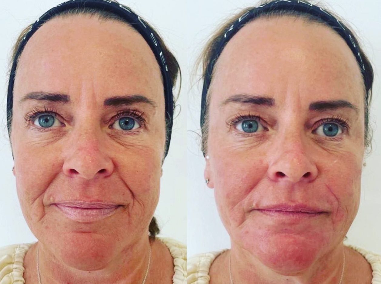 Fillers nasolabial folds 11 lines before and after