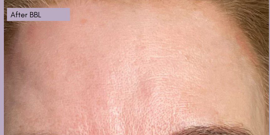 Forever Young BBL treatment forehead age spots after