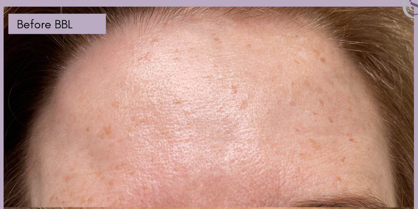 Forever Young BBL treatment forehead age spots before