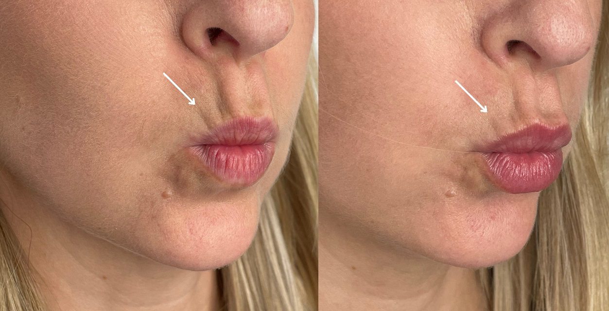 dermal fillers lip lines, barcode lines on lips before and after