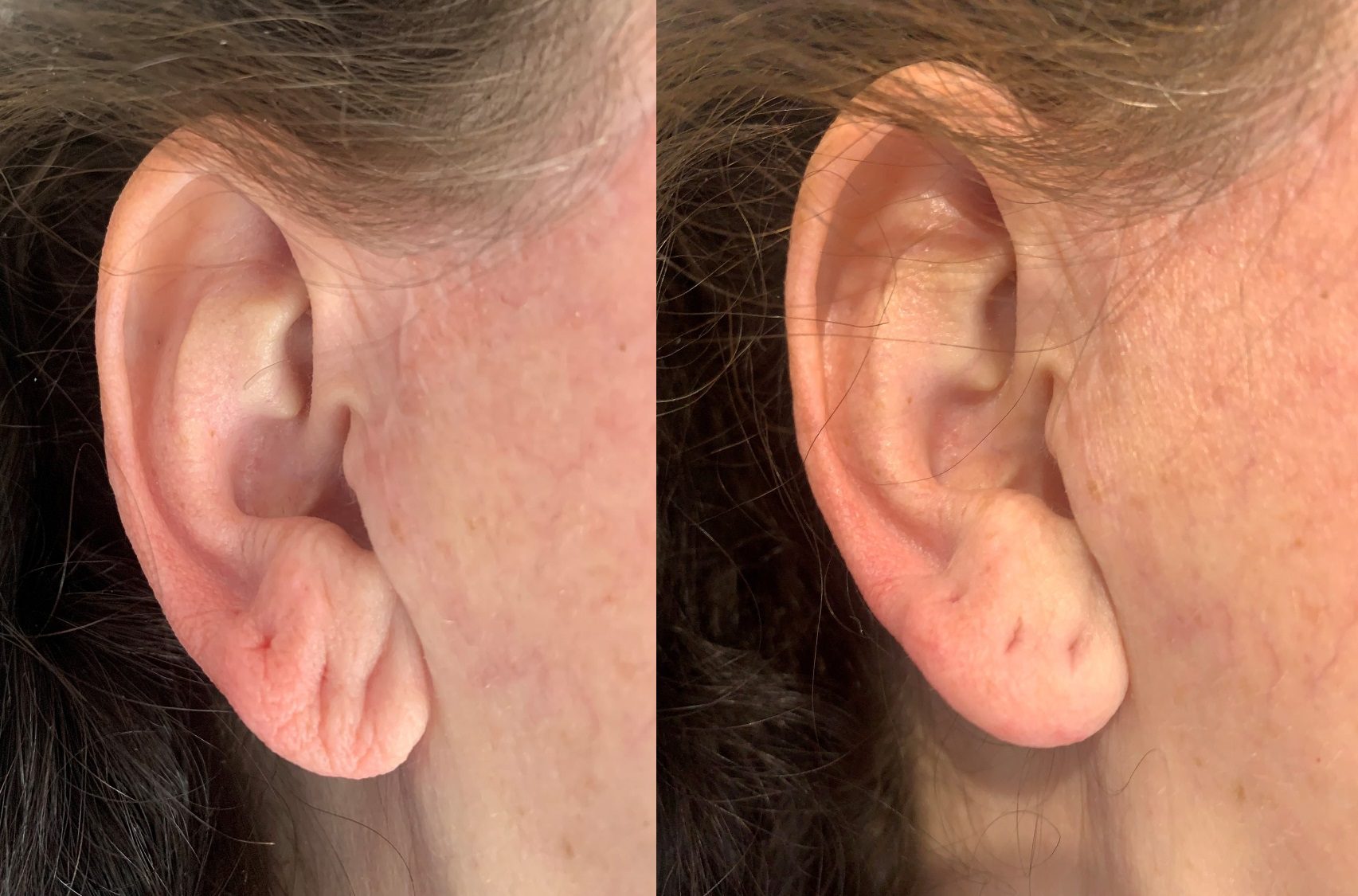 Hyaluronic acid filler for earlobe rejuvenation before and after