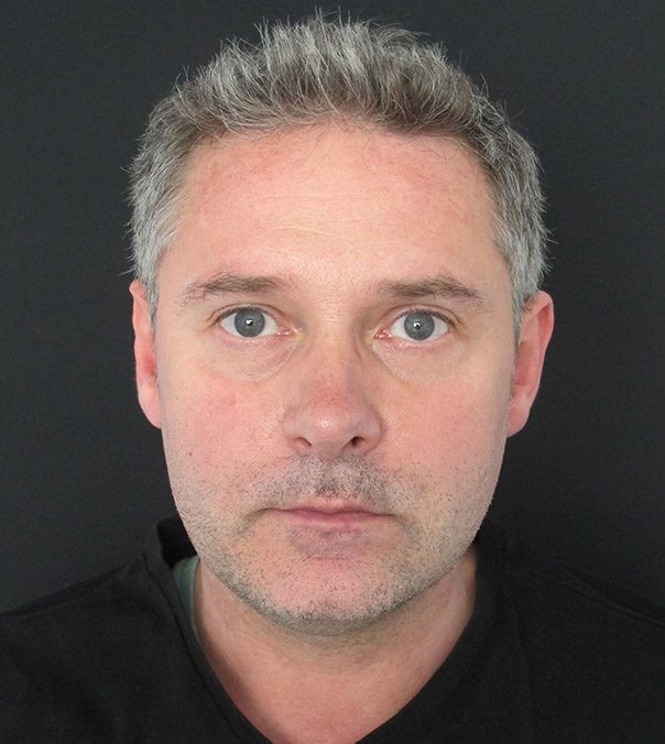 coolsculpting fat-freezing treatment on double chin after