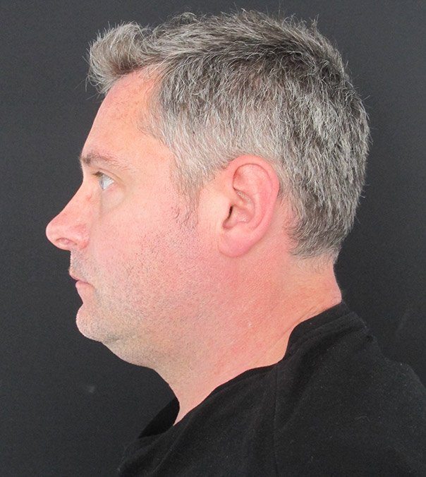 A gentleman following CoolSculpting treatment for a double chin