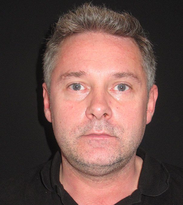 CoolSculpting for a double chin before